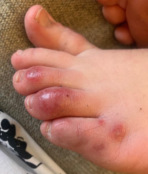 COVID toes other rashes latest possible rare virus signs AP News